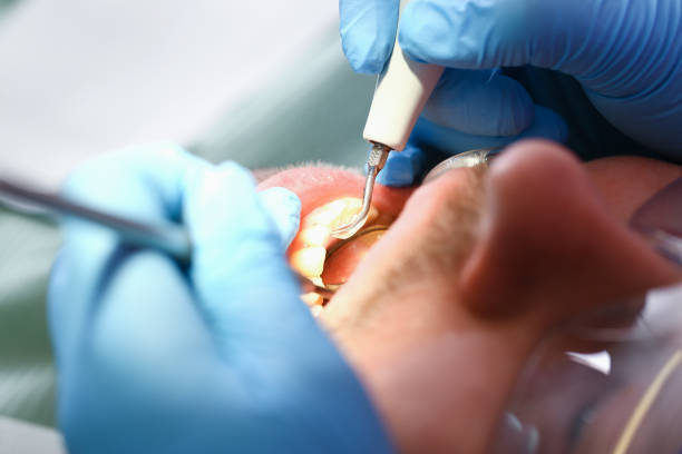 Best Emergency Wisdom Teeth Removal in Montgomery, IL
