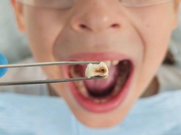 Best Emergency Tooth Extraction in Montgomery, IL