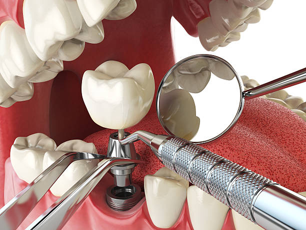 Best Emergency Tooth Extraction in Montgomery, IL